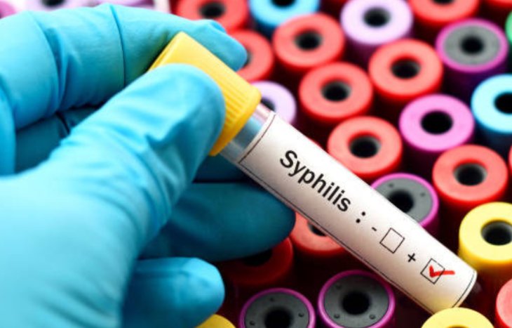 Test sífilis