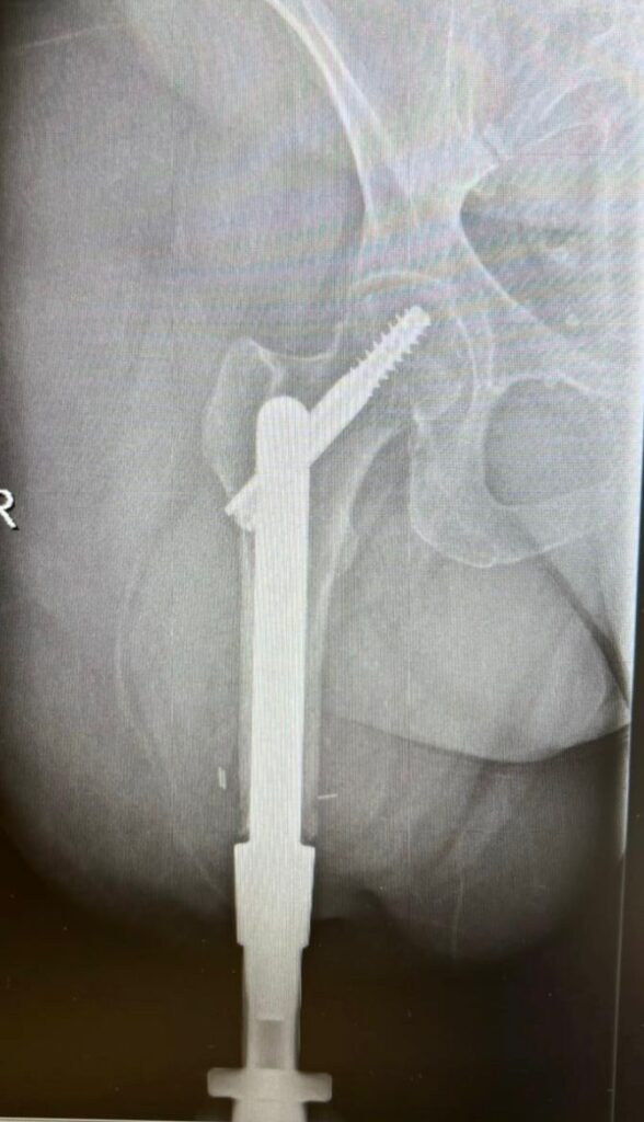 El Hospital Insular implanta con éxito una prótesis osteointegrada. Radiografía de la prótesis osteointegrada implantada por el equipo del Hospital Universitario Insular de Gran Canaria/ Gobierno de Canarias.