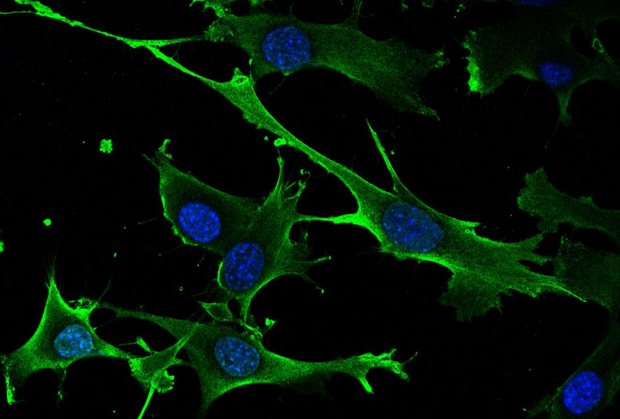 Descubierto un nuevo gen inductor de cáncer y sus debilidades